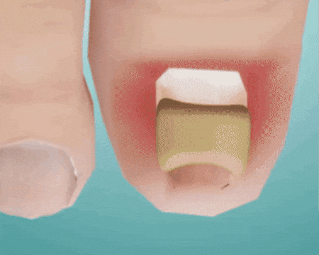 Nail Repair Patches – Instant Fix for Cracked & Split Nails